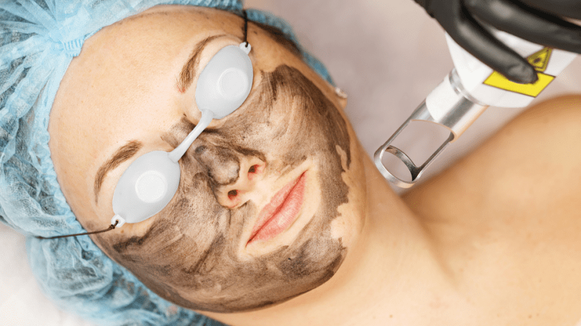 3 Reasons Carbon Facials Are Still Booming