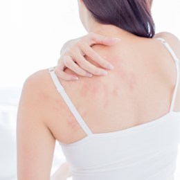 eczema support