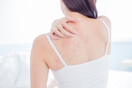 eczema support