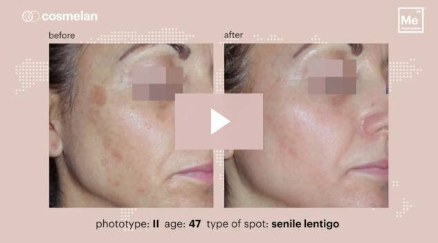 cosmelan: the world’s leading depigmentation method